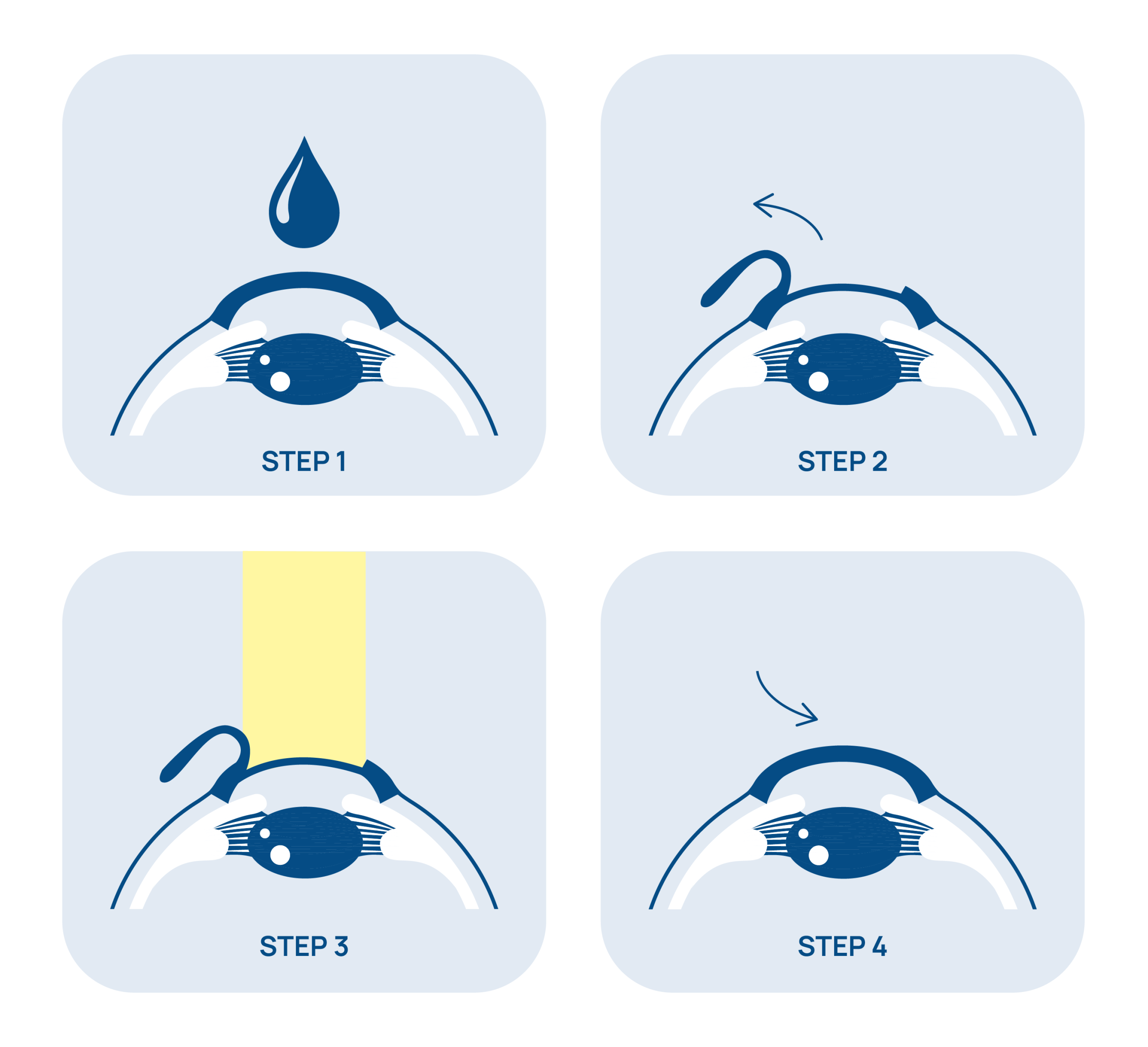 Le 4 fasi dell'intervento Femto-LASIK: anestesia, creazione del flap, laser, riposizionamento