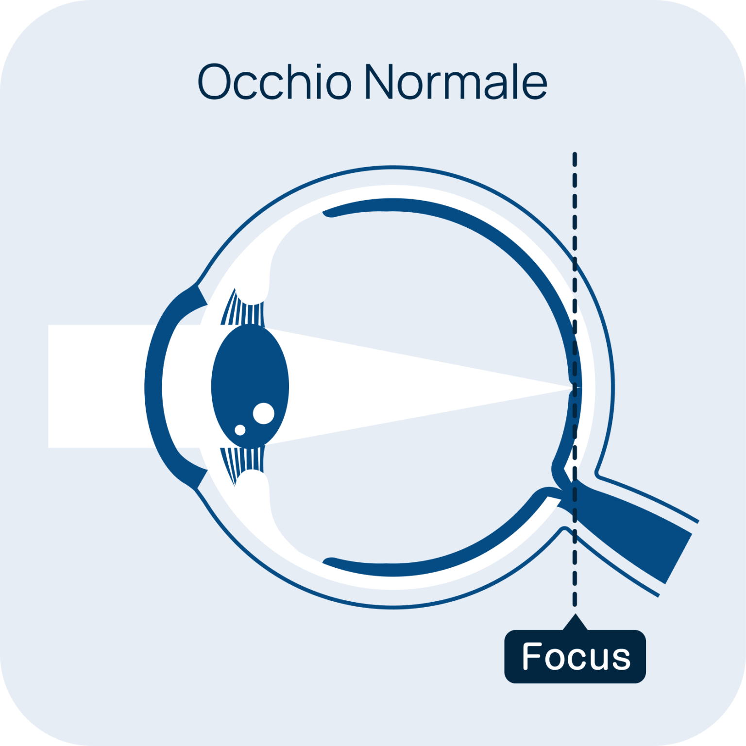 Occhio normale